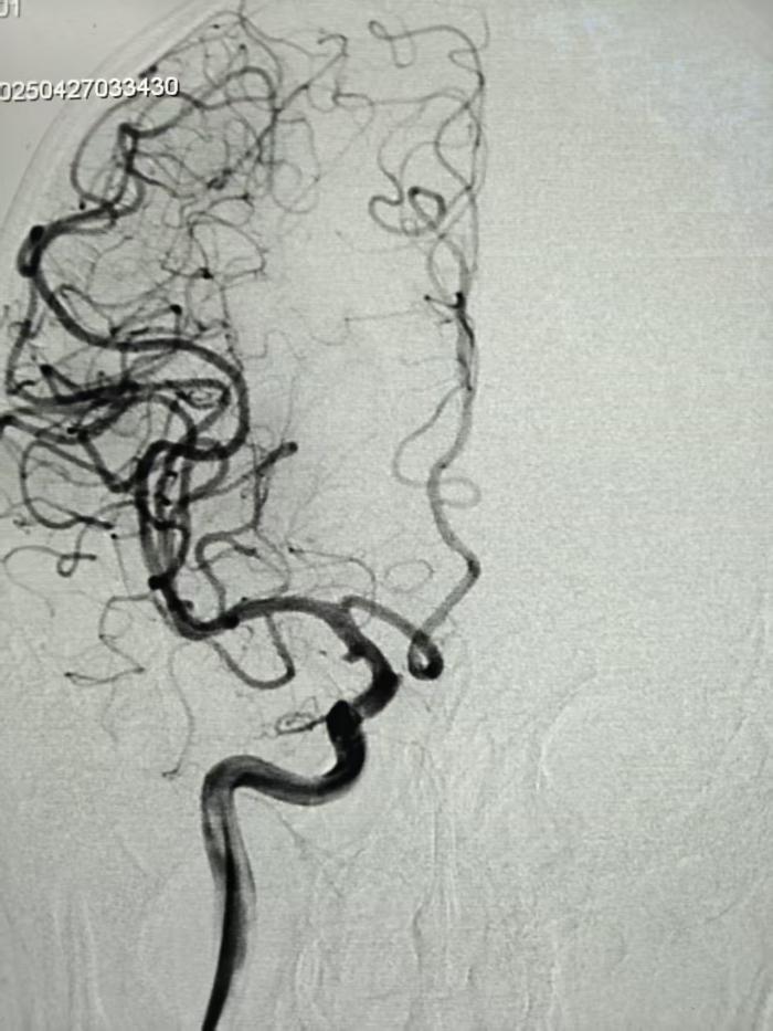 八旬老人颅内“双高危”命悬一线 三甲医院79分钟打通“生命通道”1 (3).jpg