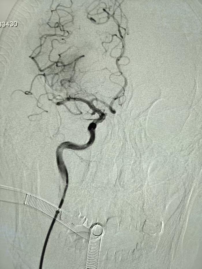 八旬老人颅内“双高危”命悬一线 三甲医院79分钟打通“生命通道”1 (2).jpg