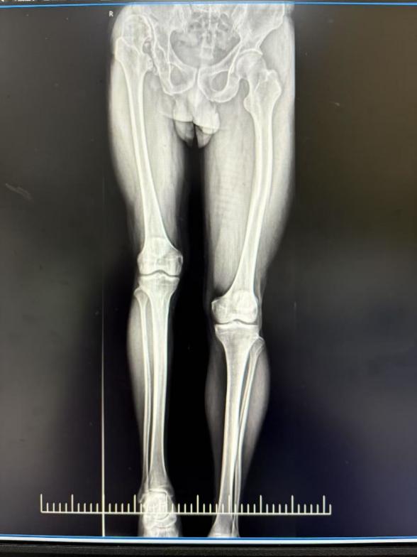 突破三大技术壁垒！一台手术让患者告别60年疾苦1 (4).jpg