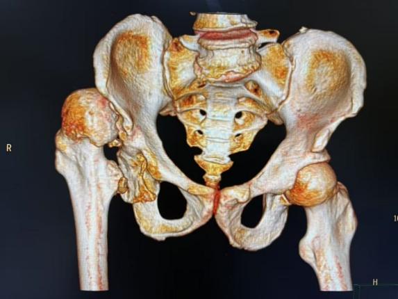 突破三大技术壁垒！一台手术让患者告别60年疾苦1 (3).jpg