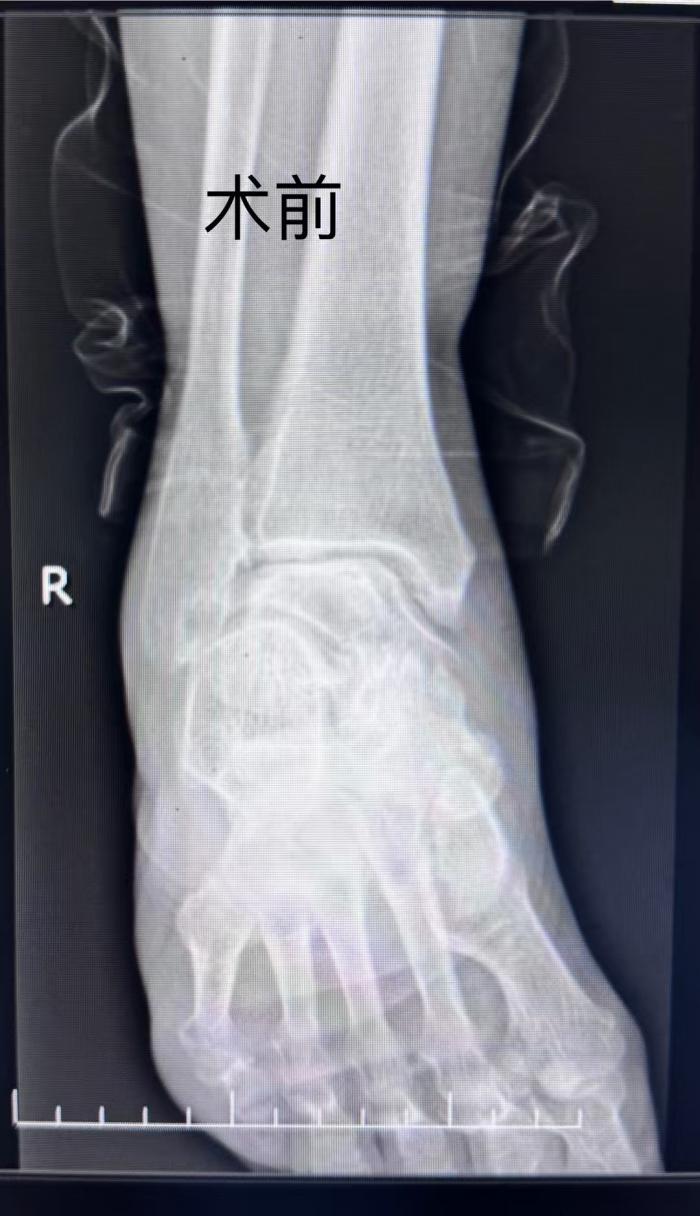 郴州市首例！湘南学院附属医院成功实施 3D 打印导板下踝关节置换术1 (2).jpg