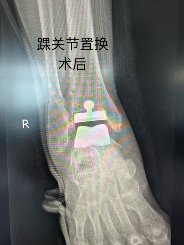郴州市首例！湘南学院附属医院成功实施 3D 打印导板下踝关节置换术1 (4).jpg