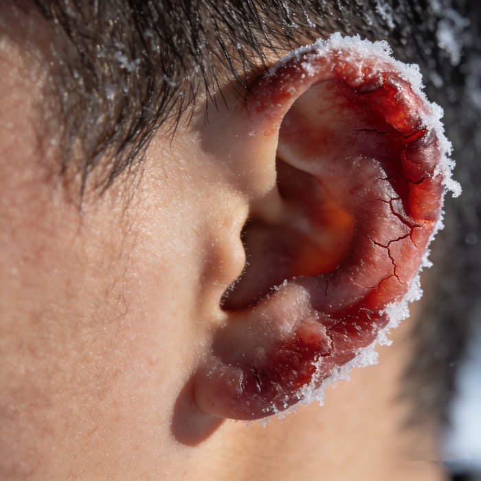 生成冻疮图片 (1)_副本.png