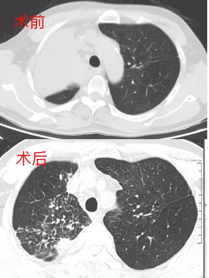 久治不愈反复胸闷！根源竟是肺癌堵死气道，幸好选对了这种手术1.jpg